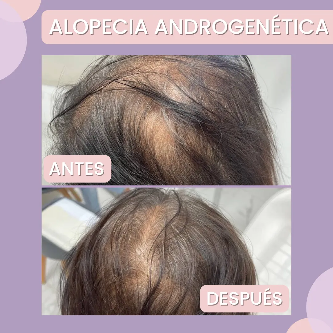alopecia